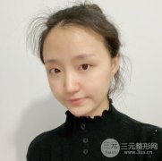 全切双眼皮1个月恢复图高清，全切双眼皮案例欢迎围观！