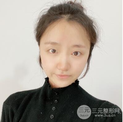 全切双眼皮前,拥有难看的单眼皮