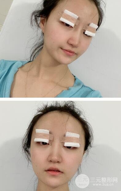 全切双眼皮前,拥有难看的单眼皮