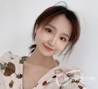 全切双眼皮1个月恢复图