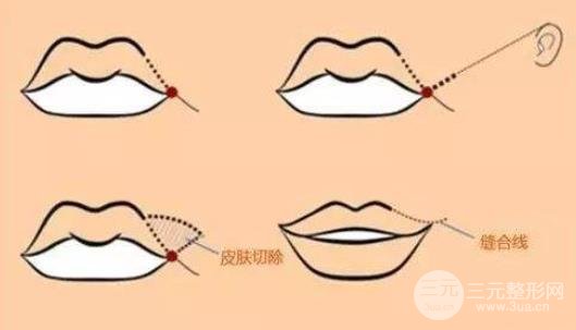 m唇手术对比照图片，手术方法及术后护理汇总~