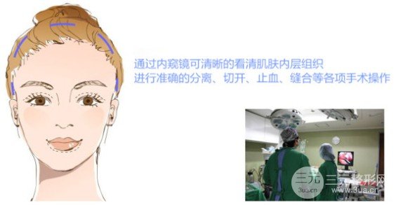 脸部除皱手术