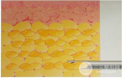 光纤溶脂和吸脂的区别