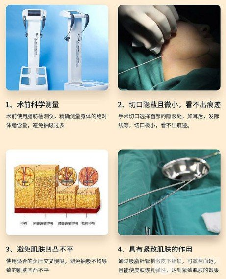 吸脂减肥手术价格