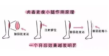 ****注射瘦腿的价格