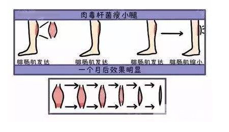 ****注射瘦腿的价格