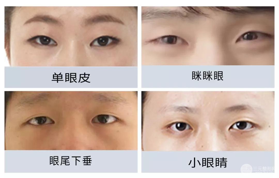 双眼皮手术价格