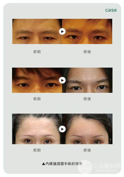 提眉术前后对比照片