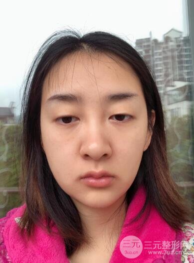 双眼皮多项整形手术的前两天