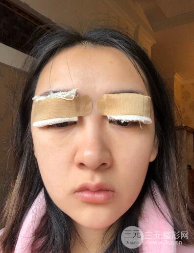 双眼皮多项整形手术的前两天