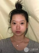 打完注射瘦脸一个月变化图反馈，注射瘦脸真人果参考