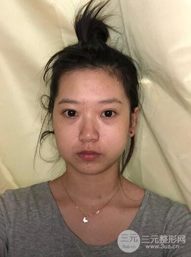 打完注射瘦脸一个月变化图反馈，注射瘦脸真人果参考