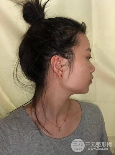 没打注射瘦脸前