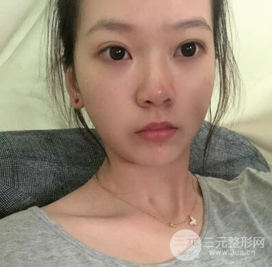 没打注射瘦脸前