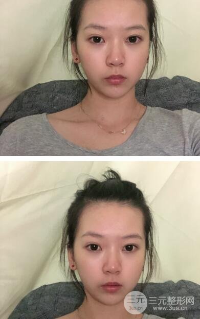 注射瘦脸操作过程