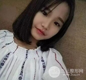 肿眼泡抽脂前后对照图反馈，摆脱“泡泡眼”如此简单！