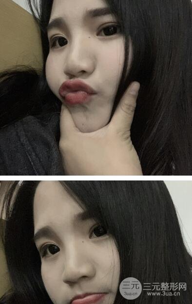 手术过程