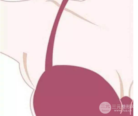 副乳严重图片