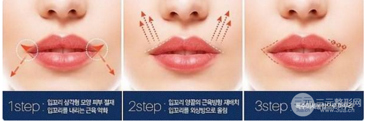 m唇手术步骤图片