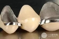 烤瓷牙一般费用是多少？果怎么样？