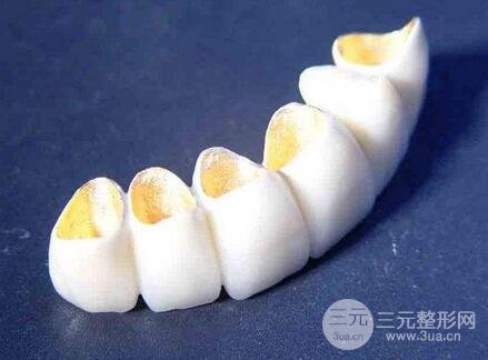 烤瓷牙一般费用