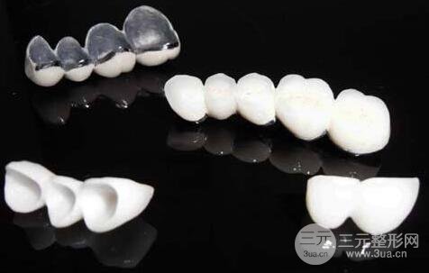 烤瓷牙一般费用