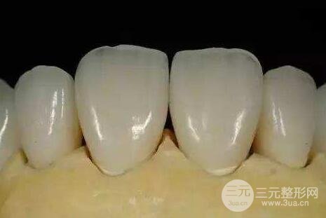 烤瓷牙一般费用