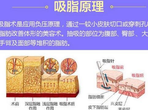 共振吸脂和水动力吸脂哪个好