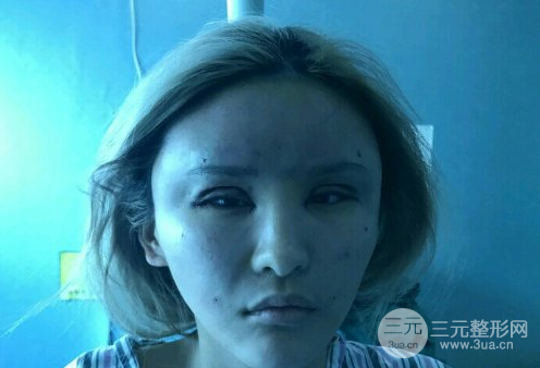 芭比眼睛双眼皮图片