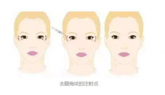 去除眼角细纹想依靠护肤品?医美除皱才科学! 去除眼角细纹想依靠护肤品?医美除皱才科学!
