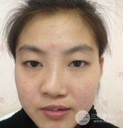 兔唇修复前后图片 重回美丽容颜！