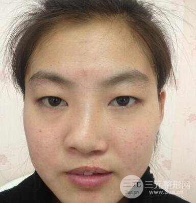 兔唇修复前后图片