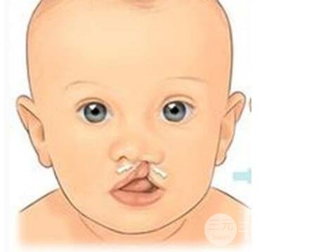 兔唇修复前后图片