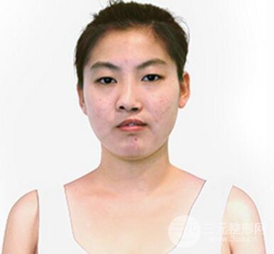 兔唇修复前后图片