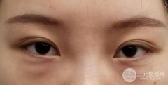 眼袋切除术后多久恢复？真实图片果参考！