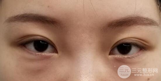 眼袋切除术后多久恢复