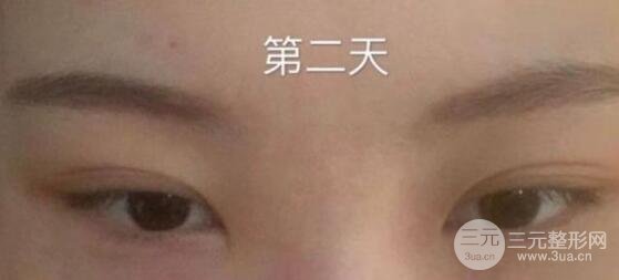 眼袋切除术后多久恢复