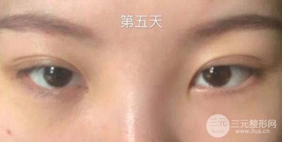 眼袋切除术后多久恢复