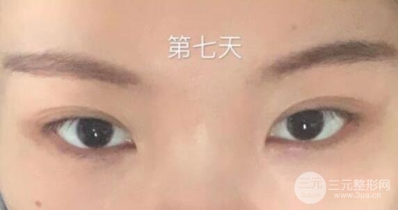 眼袋切除术后多久恢复