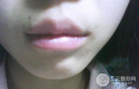 唇裂疤痕修复前后果图