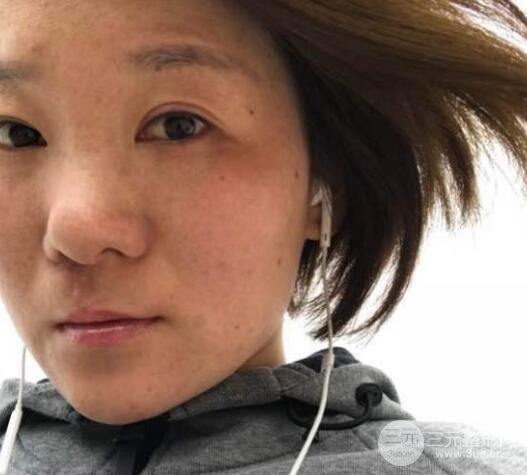 唇裂疤痕修复前后果图