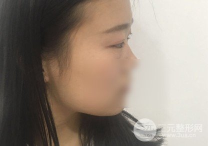 微创去眼袋**吗