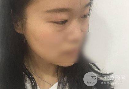 微创去眼袋**吗