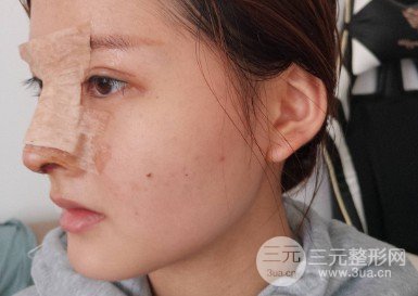 韩式自体软骨隆鼻经历