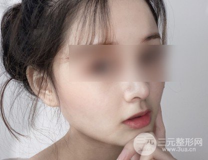 韩式自体软骨隆鼻经历