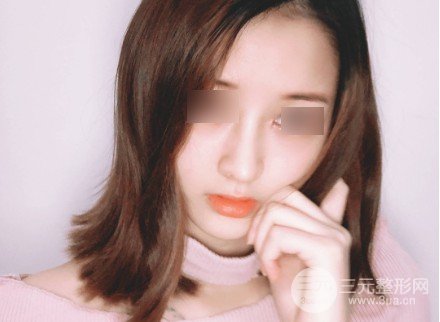 韩式自体软骨隆鼻经历