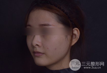 韩式自体软骨隆鼻经历