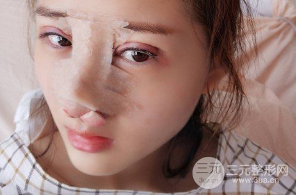 韩式自体软骨隆鼻经历