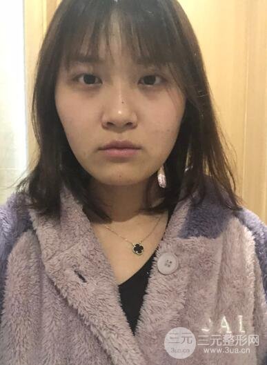 埋线双眼皮以后的护理