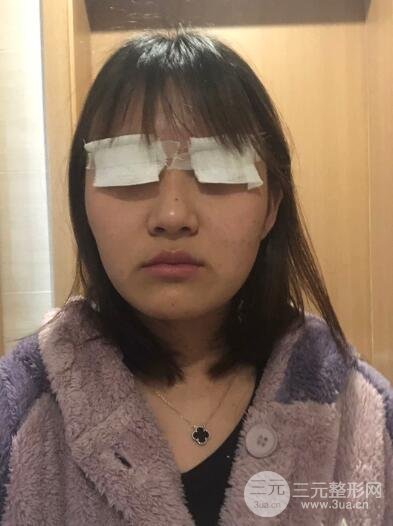 埋线双眼皮以后的护理